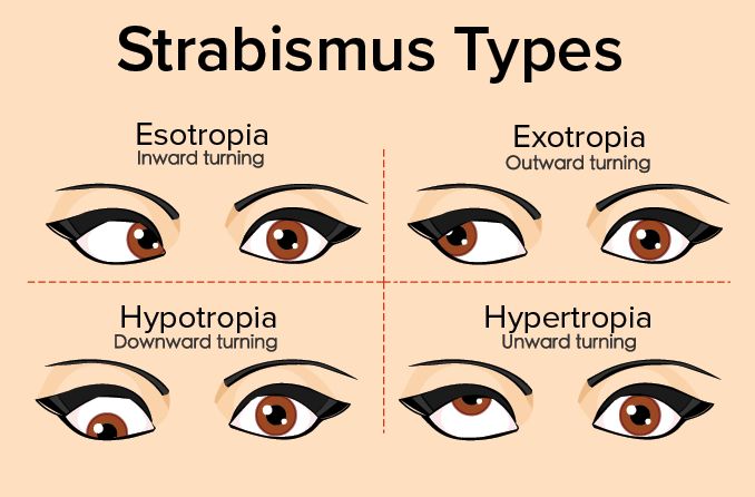 symptoms-of-squint-eye-in-kids-eye-surgery-laser