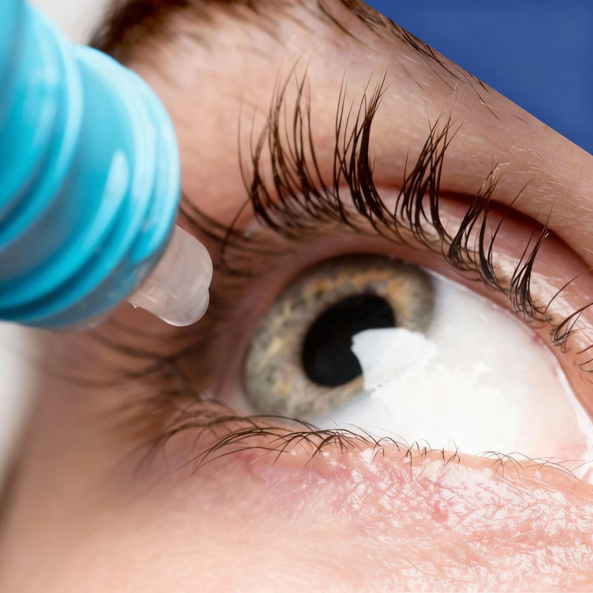 Close-up of an eye receiving a medical eye drop from a dropper, representing best cataract specialist in Thrissur.